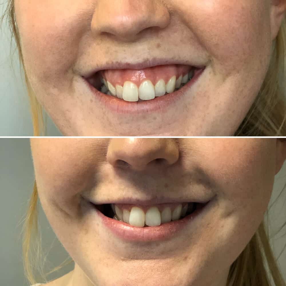 Gummysmile2